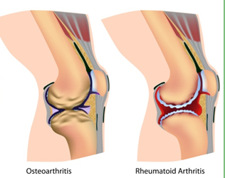 ugonjwa wa arthritis